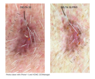 DELTA 30 PRO HEINE DERMATOSCOPE BUNDLE (K-236.28.306)