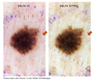 DELTA 30 PRO HEINE DERMATOSCOPE BUNDLE (K-236.28.306)