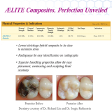 AeLite LS Low Shrinkage A1 Syringe (4gm)