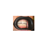 Vision Butler Small Black Mouth Retractor