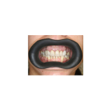 Vision Butler Small Black Mouth Retractor