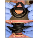 Vision Butler Small Black Mouth Retractor