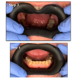 Vision Butler Small Black Mouth Retractor