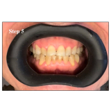 Vision Butler Small Black Mouth Retractor