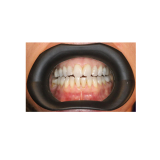 Vision Butler Original Medium Black Mouth Retractor