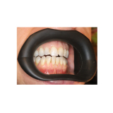 Vision Butler Original Medium Black Mouth Retractor