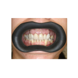 Vision Butler Original Medium Black Mouth Retractor