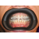 Vision Butler Large Black Mouth Retractor