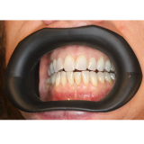 Vision Butler Large Black Mouth Retractor