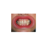 Vision Butler Small Pink Mouth Retractor