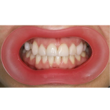 Vision Butler Large Pink Mouth Retractor