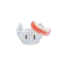 Locator 2 Implant Overdenture Patient Model
