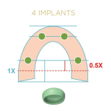 Locator Fixed Gold Starter Kit