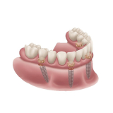 Locator Fixed Silver Starter Kit