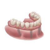 Locator Fixed Bronze Starter Kit