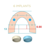 Locator Fixed Tan Anterior & Posterior Insert for 5+ 2pk