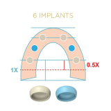 Locator Fixed Blue Mid-Arch Insert for 5+ Implants 2pk