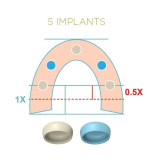 Locator Fixed Tan Anterior & Posterior Insert Processing Pk